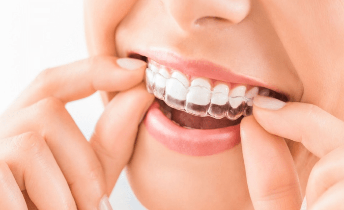 Perfecting Smiles: The Benefits of Orthodontics in Sydney Perfecting Smiles: The Benefits of Orthodontics in Sydney