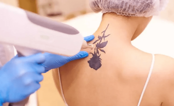 Erase Your Ink: The Revolution of Pico Laser Tattoo Removal Erase Your Ink: The Revolution of Pico Laser Tattoo Removal