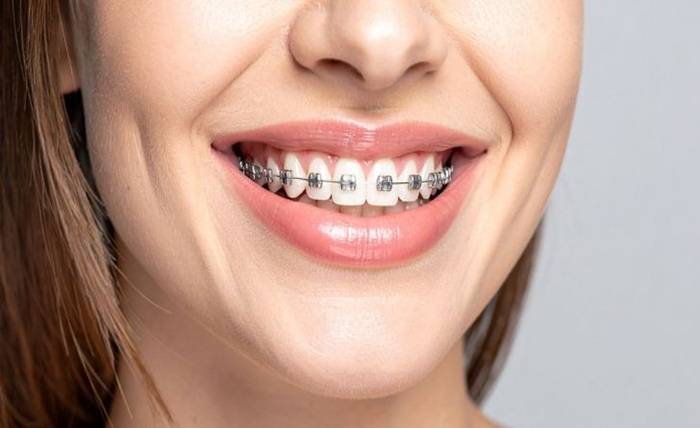 Adult Braces: A Complete Guide to Adult Orthodontics for Crowded Teeth Adult Braces: A Complete Guide to Adult Orthodontics for Crowded Teeth